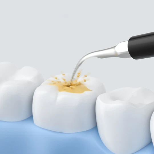 CleanSmile® | Ultraschall-Zahnreinigungsset