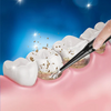 CleanSmile® | Ultraschall-Zahnreinigungsset